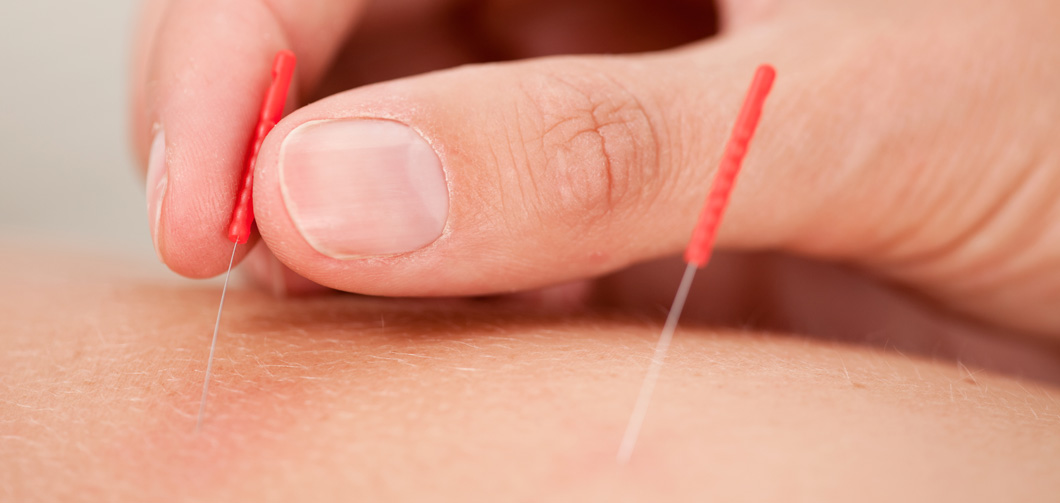 Acupuncture Treatments | Nardini Naturopathic | Dr. Pat Nardini, ND | Naturopath Toronto